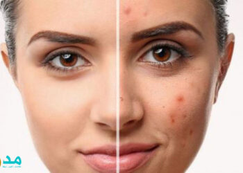 البشرة الدهنية