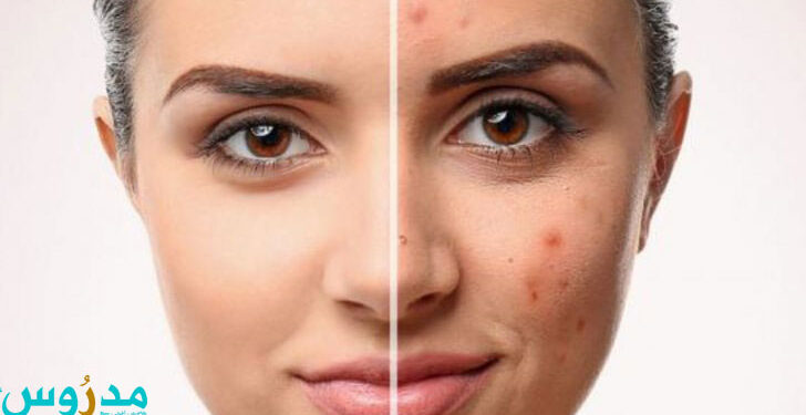 البشرة الدهنية