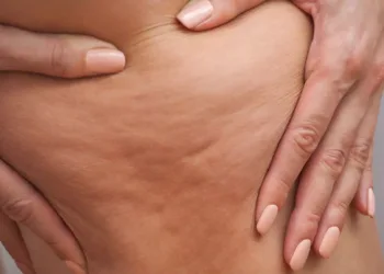 السيلولايت